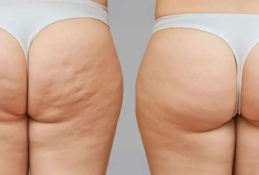 Adiposità localizzate VS Cellulite: cause, differenze e cure