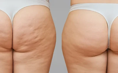 Adiposità localizzate VS Cellulite: cause, differenze e cure