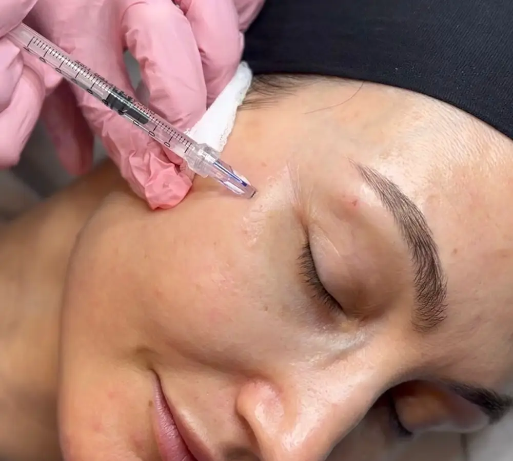 Medicina estetica - Biostimolazione