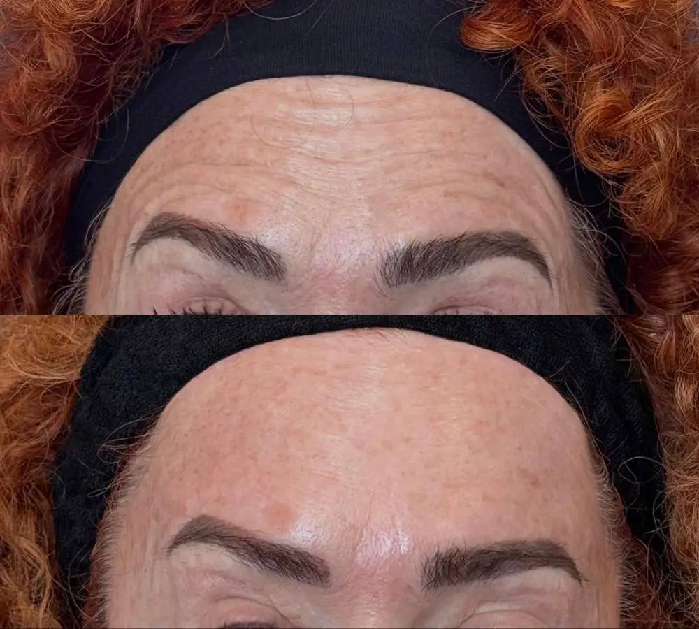 Medicina estetica - Botox