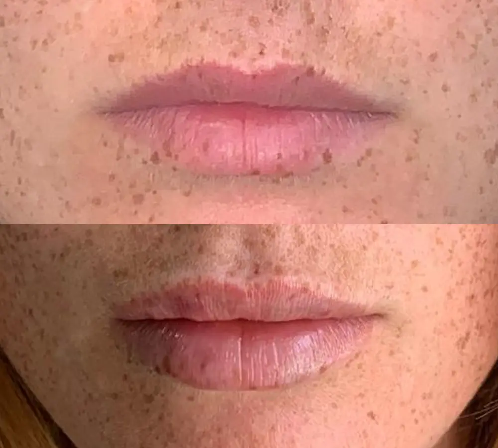 City Life - Filler Labbra